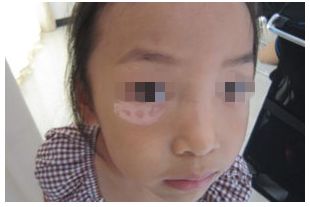 白癜风图片 白癜风图片