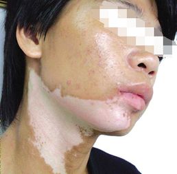 白癜风图片 白癜风图片